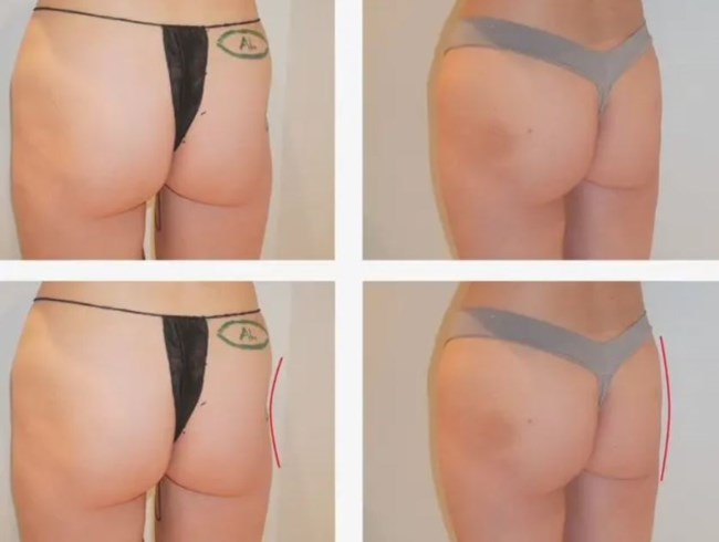 ΠΛΑΣΤΙΚΗ ΧΕΙΡΟΥΡΓΙΚΗ ΛΙΠΟΣ