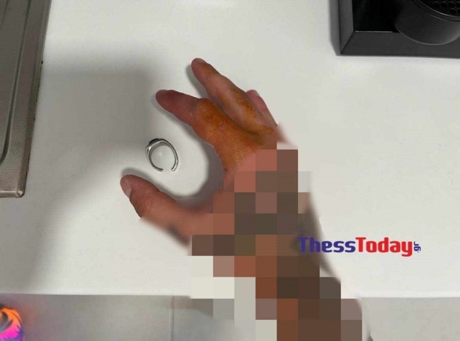 Χαλκιδική: Γιατροί έψαχναν στο Youtube για να αφαιρέσουν δαχτυλίδι από χέρι ασθενούς - Τελικά φώναξαν... ηλεκτρολόγο με τροχό