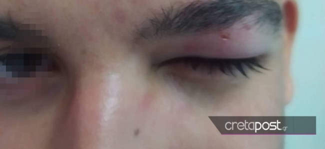 Νταής κρητικός οδηγός δεν σταμάτησε σε διάβαση και έσπασε στο ξύλο μαθητή που του έκανε παρατήρηση