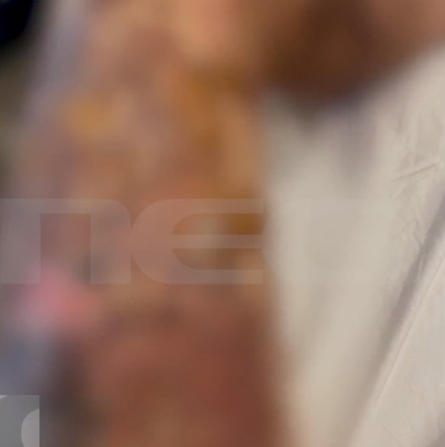 Εικόνες σοκ: Χρησιμοποίησε αποφρακτικό για τον νεροχύτη και εξερράγη πάνω της - Θυμήθηκα την Παλιοσπύρου και έριξα νερό