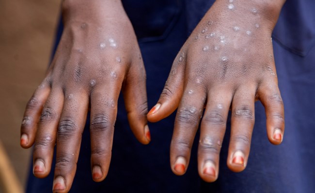 Mpox