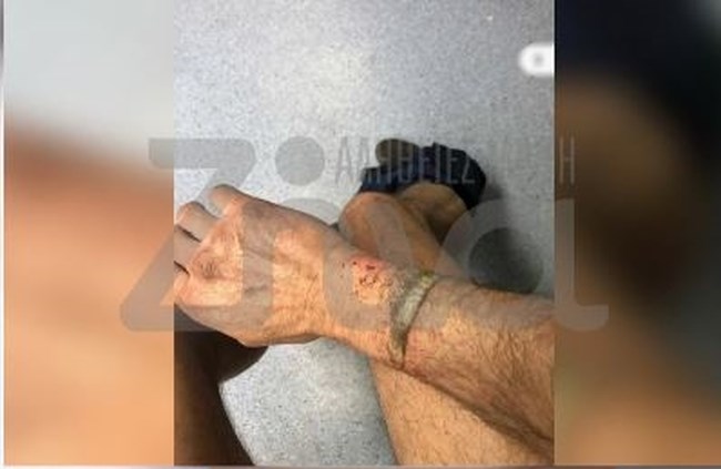 Τέμπη: Φωτογραφίες από τα χημικά εγκαύματα πυροσβεστών - "Έβγαλα το γάντι και είδα το χέρι άσπρο, είχε νεκρώσει ο ιστός"