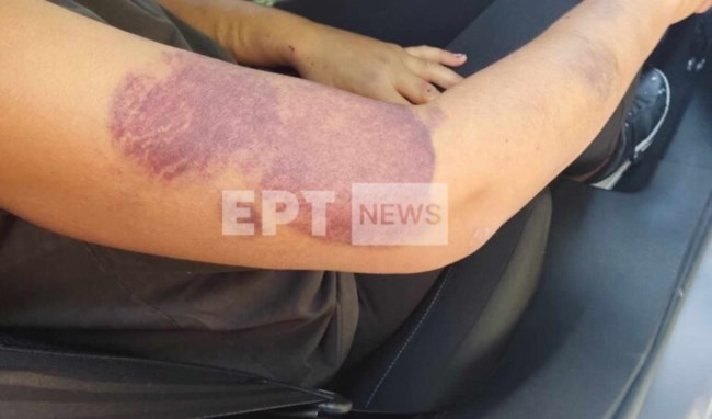 Διδυμότειχο - Το ιατροδικαστικό πόρισμα: Τη βίαζε επανειλημμένα και τη χτυπούσε με ξύλο - Την… έβγαζε βόλτα με μάσκα και γυαλιά