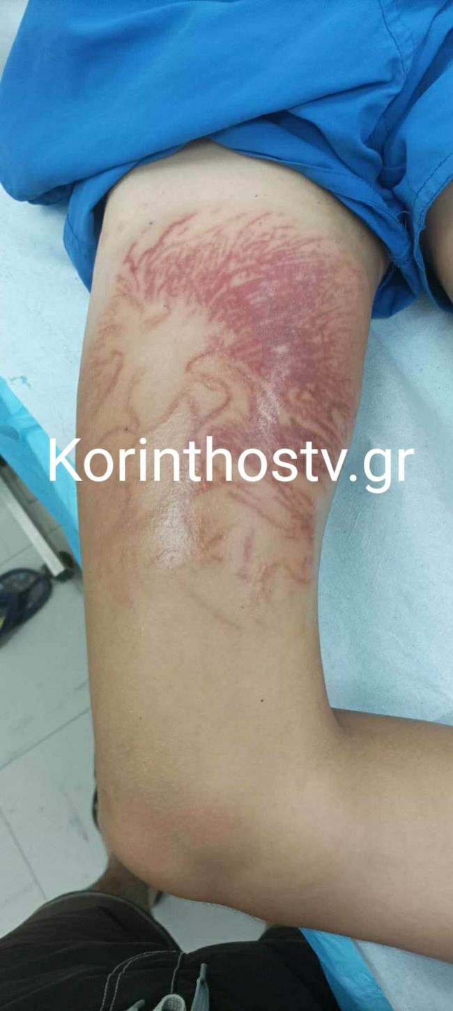 Τσίμπημα θαλάσσιας ανεμώνης