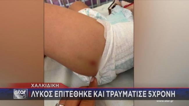 Χαλκιδική: Σοκάρουν τα τραύματα της 5χρονης που δέχθηκε επίθεση από λύκο σε παραλία [εικόνες]