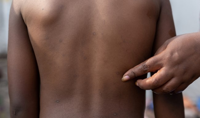 HEALTH-MPOX