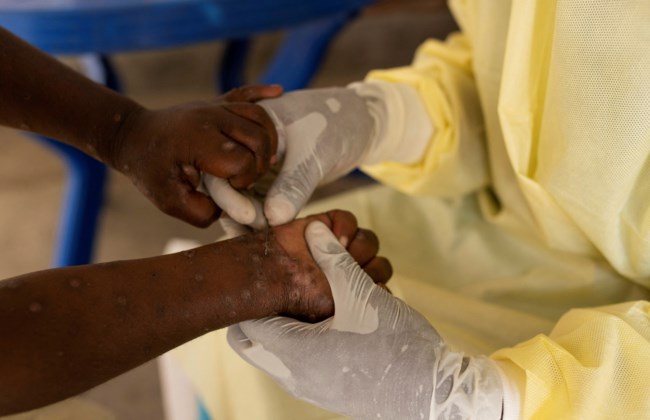 HEALTH-MPOX