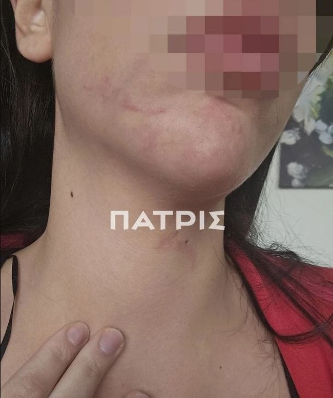 ΚΑΚΟΠΟΙΗΣΗ ΕΔΕΣΣΑ