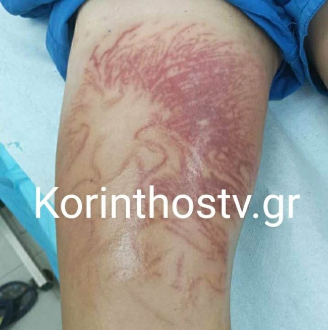 Κορινθία: Στο νοσοκομείο 9χρονος μετά από τσίμπημα θαλάσσιας ανεμώνης - Σκληρές εικόνες