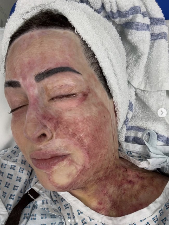 Ιωάννα Παλιοσπύρου: Βίντεο από την αποκατάσταση μετά την επίθεση με βιτριόλι - "Δεν ξέρω πως αντέχω"