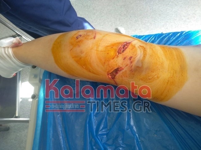 Ξεσπά ο σύζυγος της 34χρονης που έπεσε θύμα αγέλης σκύλων - "Δεν επενέβη ποτέ η αστυνομία"