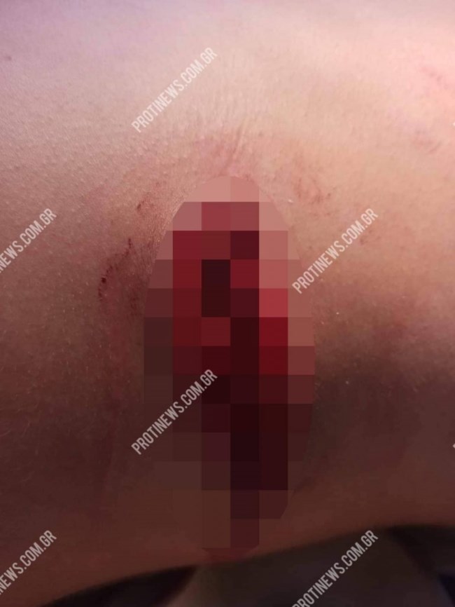 Ηλεία: Μαχαιρώματα έξω από νυχτερινό κέντρο - Ένας τραυματίας