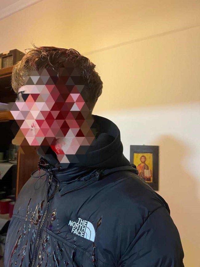 Θεσσαλονίκη: Σοκάρει η εικόνα του 16χρονου από την επίθεση με σωλήνα – "Ήταν μέσα στα αίματα"