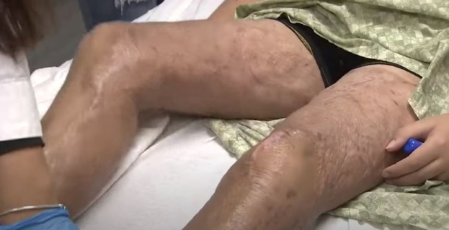 Μπαινόβγαινε επί 6 μήνες στο νοσοκομείο και υπεβλήθη σε 50 χειρουργεία