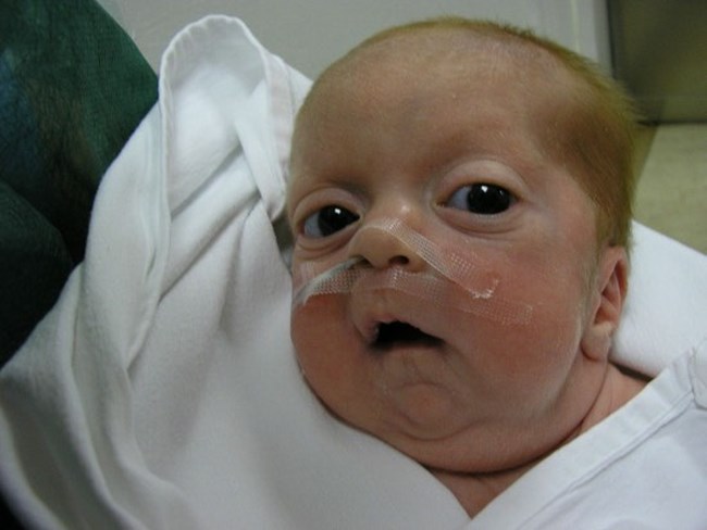 Η ιστορία της Μαριλένας που πάσχει από το σπάνιο σύνδρομο Οκαμάτο - "Αυτό το παιδί έχει τεράστια θέληση για ζωή"