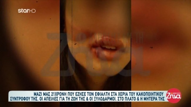 Εφιάλτης για την 21χρονη Βαλέρια: Θύμα κακοποίησης από τον σύντροφό της - "Με χτύπησε με κλειδί στο πρόσωπο"