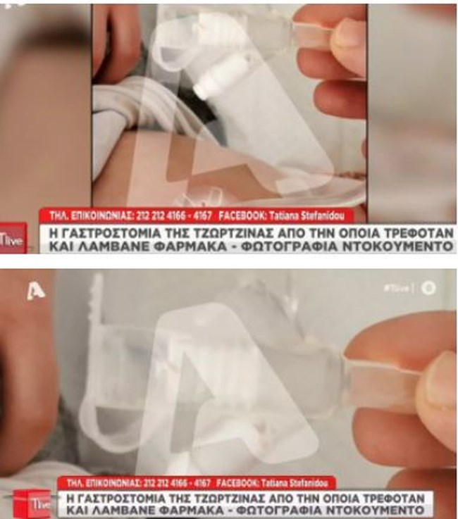 Συγκλονίζει η νοσηλεύτρια της Τζωρτζίνας: "Είχε βιώσει πολύ άσχημες καταστάσεις" - Η γαστροστομία από την οποία τρεφόταν