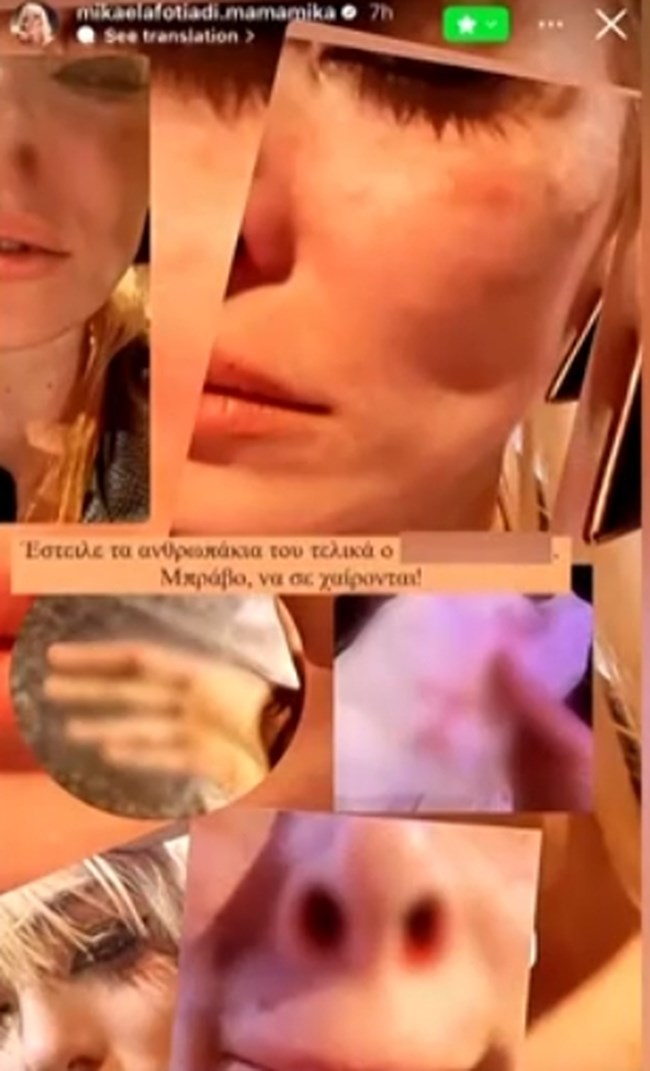 Θύμα ξυλοδαρμού η Μικαέλα Φωτιάδη - Οι φωτογραφίες με μώλωπες και η προειδοποίηση: "Κανείς δεν με σακατεύει εμένα"
