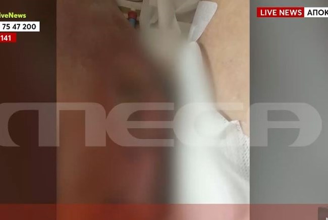 Εφιάλτης για αδέρφια που έκαναν λιποαναρρόφηση - Έσπαγαν τα ράμματα - "Μια χαρά είσαι" η απάντηση του γιατρού [βίντεο]