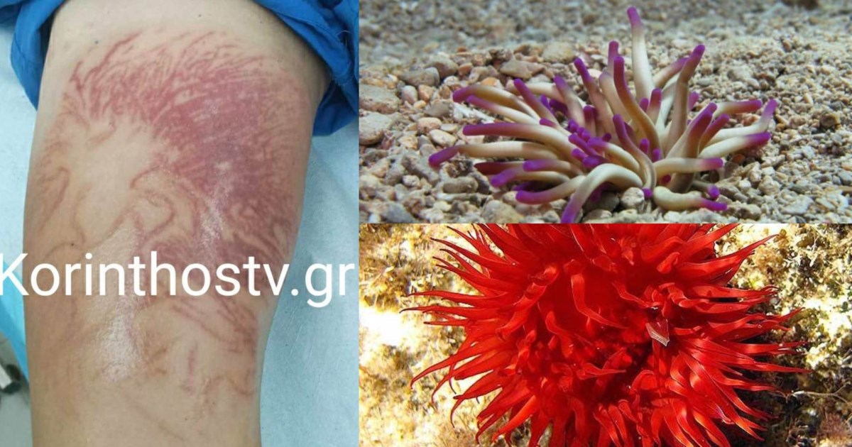 Το φαρμακείο των διακοπών: Τι πρέπει να περιέχει για να αντιμετωπίσουμε τα τσιμπήματα [βίντεο]