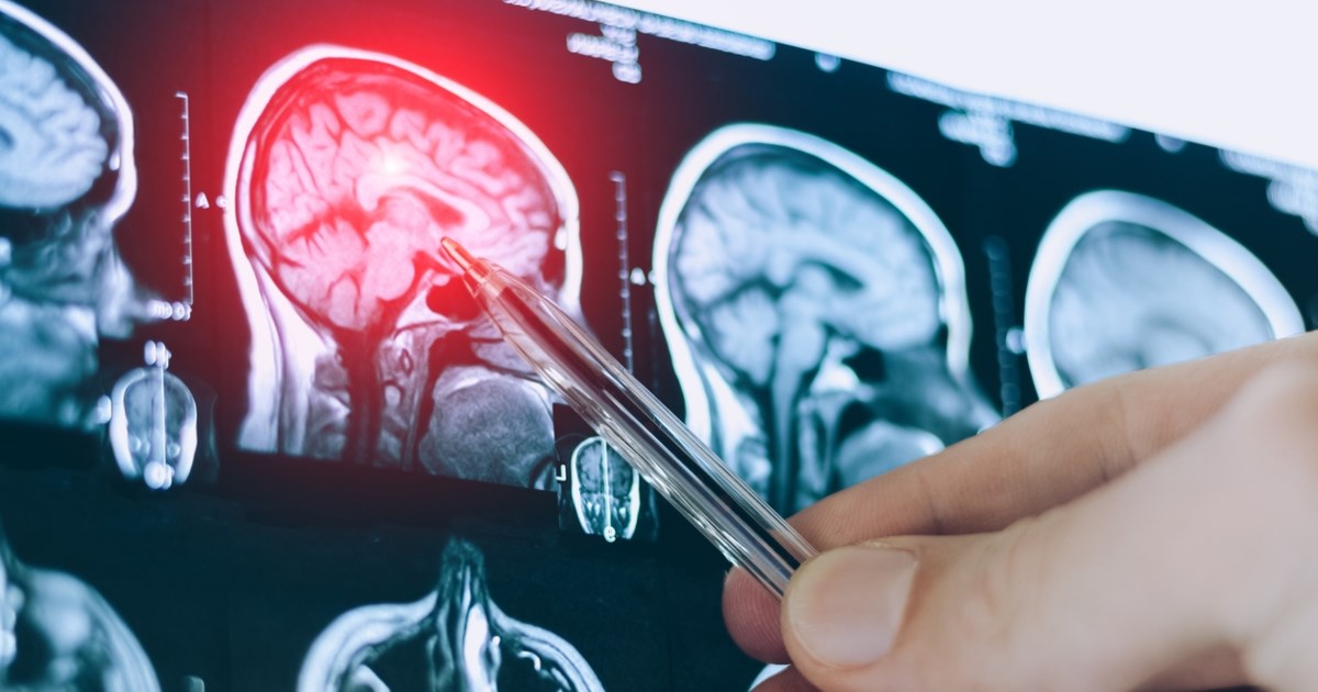 Ανεύρυσμα εγκεφάλου: Αυτά είναι τα προειδοποιητικά σημάδια - Μπορούμε να το προλάβουμε;