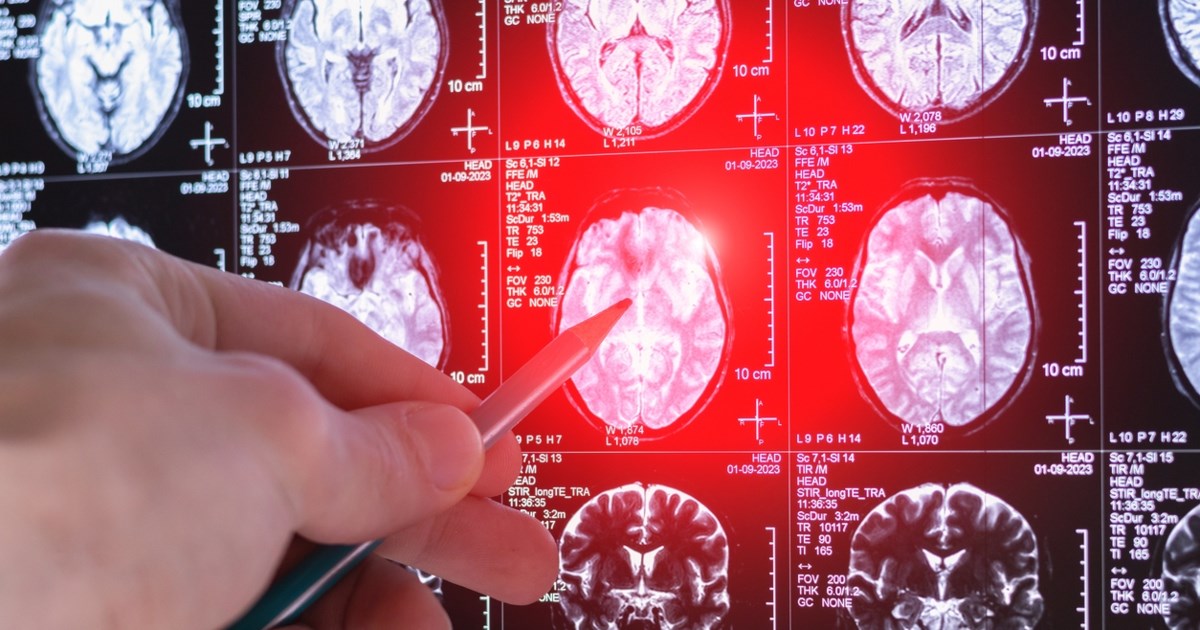 Ψαλτοπούλου: Τι να προσέξουμε για να μειώσουμε την πιθανότητα για εγκεφαλικά επεισόδια