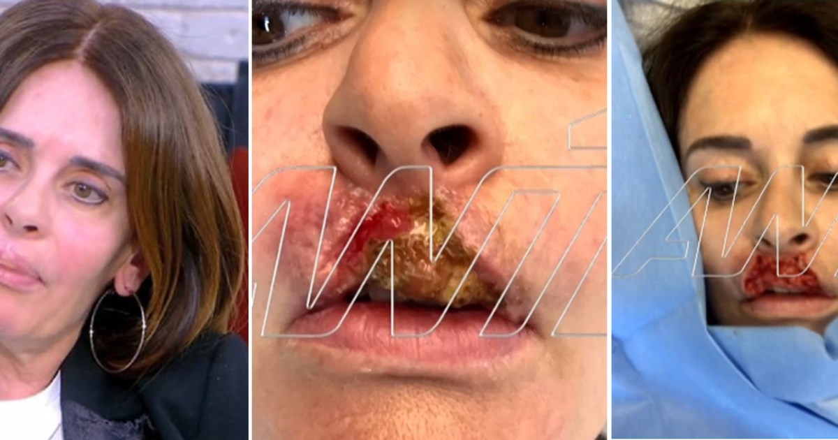 Το μαρτύριο της Κατερίνας Πλουμιδάκη από κολλαγόνο στα χείλη: "Έχω κάνει 12 χειρουργεία, δεν έμεινε τίποτα από το πρόσωπό μου" - εικόνα 2