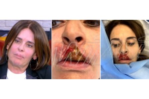 Το μαρτύριο της Κατερίνας Πλουμιδάκη από κολλαγόνο στα χείλη: "Έχω κάνει 12 χειρουργεία, δεν έμεινε τίποτα από το πρόσωπό μου" - εικόνα 2