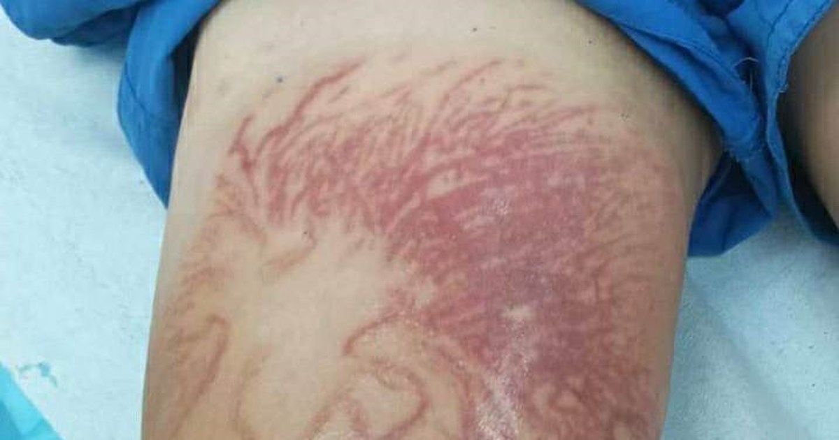 Το φαρμακείο των διακοπών: Τι πρέπει να περιέχει για να αντιμετωπίσουμε τα τσιμπήματα [βίντεο] - εικόνα 2