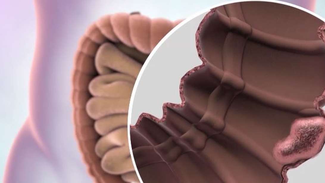 Οταν ο καρκίνος του παχέος εντέρου "χτυπάει" νωρίς: Ποιοι διατρέχουν μεγαλύτερο κίνδυνο