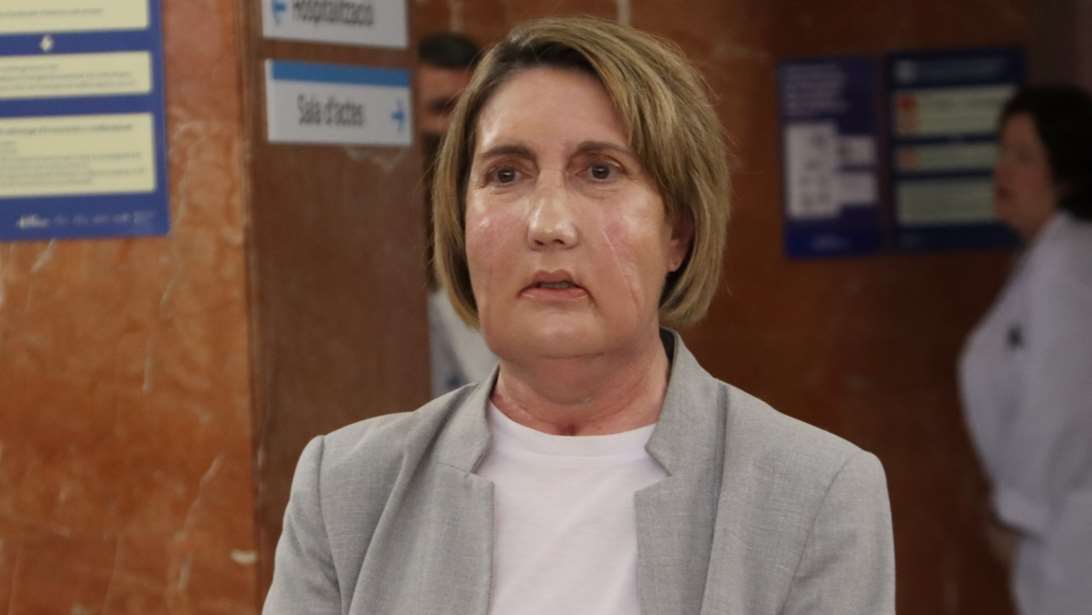 Επανάσταση στην ιατρική: Η πρώτη μεταμόσχευση προσώπου στον κόσμο με δότρια που υποβλήθηκε σε ευθανασία