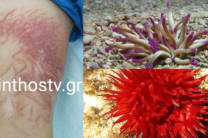 Η θέρμανση των θαλασσών αλλάζει τη βιοποικιλότητα - Τι αποκαλύπτει ειδικός για τις θαλάσσιες ανεμώνες