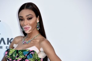 Αθηναΐς Νέγκα: Δείχνει για πρώτη φορά τη λεύκη στο κορμί της - Οι λευκές κηλίδες στα πόδια και τα χέρια της - εικόνα 3