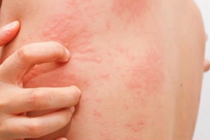 Κρούσμα νορβηγικής ψώρας σε δημοτικό σχολείο στον Κορυδαλλό:  Ανιχνεύτηκε μαθητής με τη νόσο