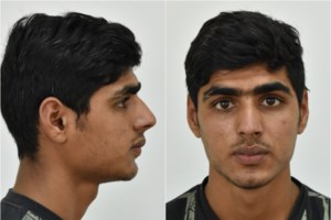 Σοκ στο Βόλο: Δίωξη σε 32χρονο για βιασμό 15χρονης με νοητική υστέρηση