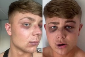 Μακάβριο εύρημα σε παραλία στη Ζάκυνθο - Ανθρώπινο οστό βρέθηκε σε παραλία