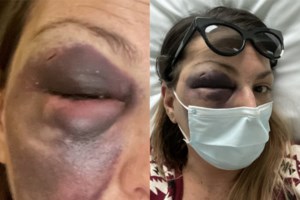 Στεφανία Τζαφέρη: "Δέχτηκα απειλές ότι θα μου κλείσουν και το άλλο μάτι" - Σε κατάσταση σοκ η food blogger