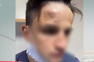 Συγκλονίζει ο 17χρονος μετά τον ξυλοδαρμό σοκ: "Είχα παντού αίματα, μώλωπες, καρούμπαλα - Θα χρειαστώ χειρουργείο στη γνάθο"