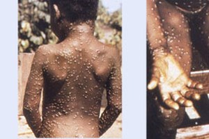 Γιατί κάποιοι δεν κόλλησαν κορονοϊό; - Αποκαλυπτική ανάλυση της Deutsche Welle - εικόνα 2