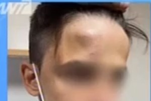 Απίστευτο περιστατικό στην Κύπρο: 18χρονη δάγκωσε 52χρονο και... του έκοψε δάχτυλο