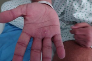 Αλτσχάιμερ: Για πρώτη φορά φάρμακο επιβραδύνει την απώλεια μνήμης και αλλάζει την πορεία της νόσου - Τι έδειξε η μελέτη