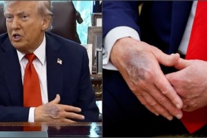 Ανησυχία για την κατάσταση της υγείας του Μπάιντεν: Υποβλήθηκε σε επέμβαση για καρκίνο του δέρματος