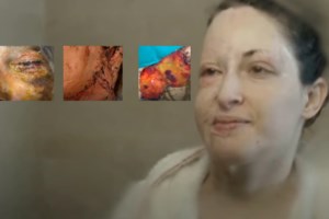 Ιωάννα Παλιοσπύρου: Το έγκαυμά της ίσως είναι το μεγαλύτερο παγκοσμίως, λέει η γιατρός της - εικόνα 4