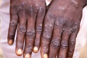 Ευλογιά των πιθήκων: Με ειδικές κάψουλες η αεροδιακομιδή του 29χρονου και της συντρόφου του από την Κεφαλονιά