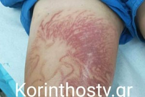 Θαλάσσια ανεμώνη: Το επικίνδυνο σαρκοφάγο ζώο που τσίμπησε τον 9χρονο στην Κορινθία - Πώς θα την αναγνωρίσετε - εικόνα 2