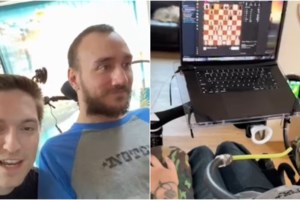 Η Neuralink του Ίλον Μασκ παραδέχθηκε δυσλειτουργία στο εμφύτευμα εγκεφάλου που τοποθέτησε σε ασθενή