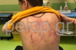 Θεσσαλονίκη: Ποινή χάδι σε άνδρα που "σάπισε" στο ξύλο τον δίχρονο γιο της συντρόφου του