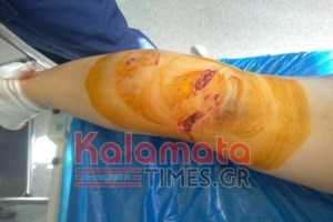 Καλαμάτα: "Δεν είπα ποτέ ότι με δάγκωσαν τα σκυλιά, αλλά η κατάσταση είναι ανεξέλεγκτη", λέει η 45χρονη [Βίντεο] - εικόνα 2