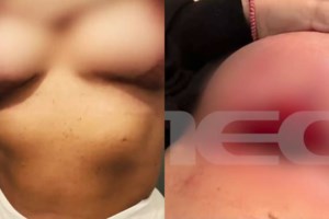 Νέες μαρτυρίες για επεμβάσεις στήθους από πλαστικό χειρουργό - "χασάπη": "Έπαθα θρόμβωση στον αριστερό μαστό" [βίντεο] - εικόνα 2