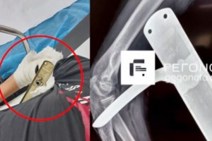 Αδιανόητο περιστατικό στο Πανεπιστημιακό Νοσοκομείο Λάρισας: Πόρτα έπεσε και έσπασε το χέρι εργαζόμενης